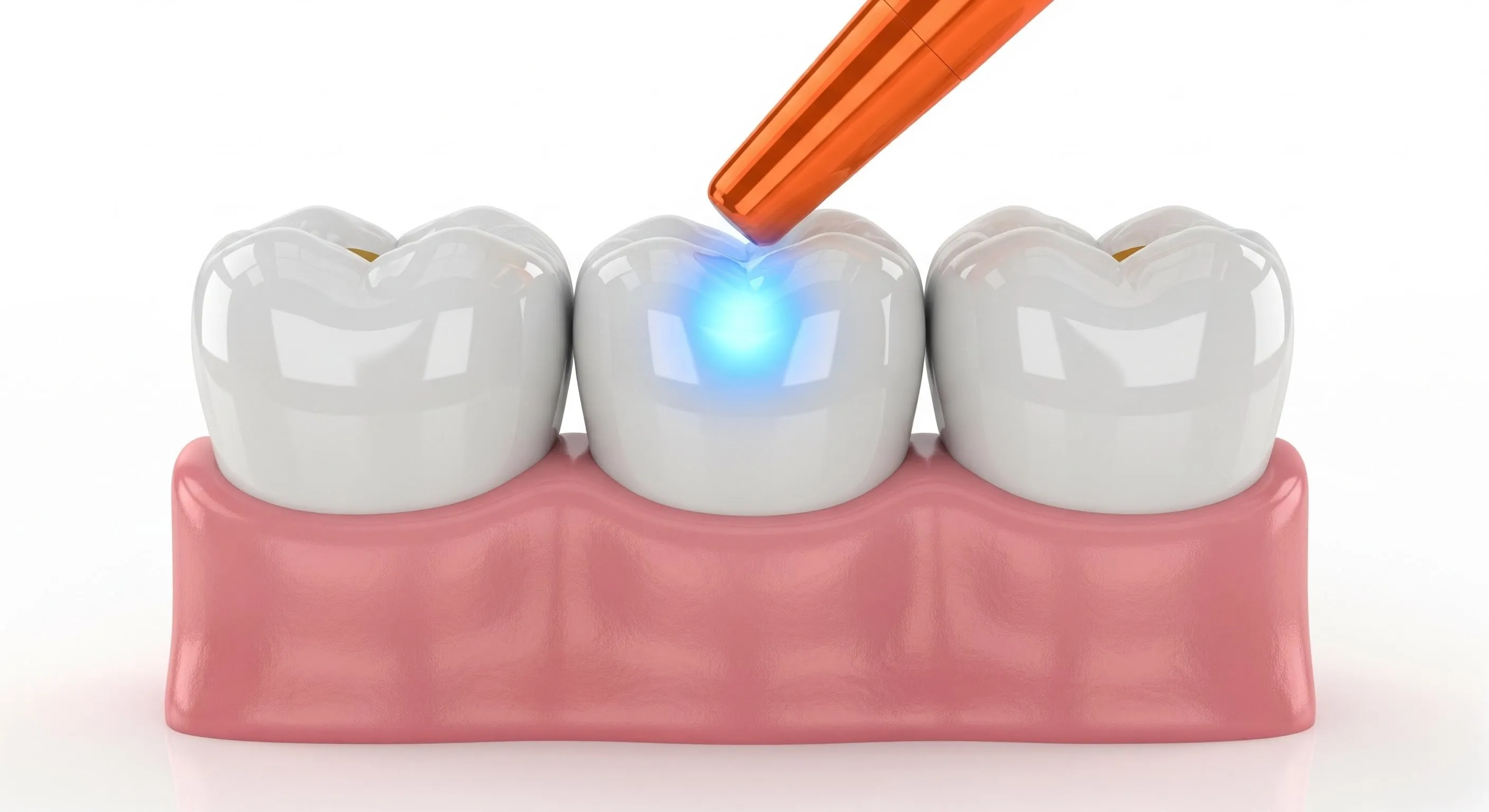 Composite Fillings Cost and Pricing Information in Austin