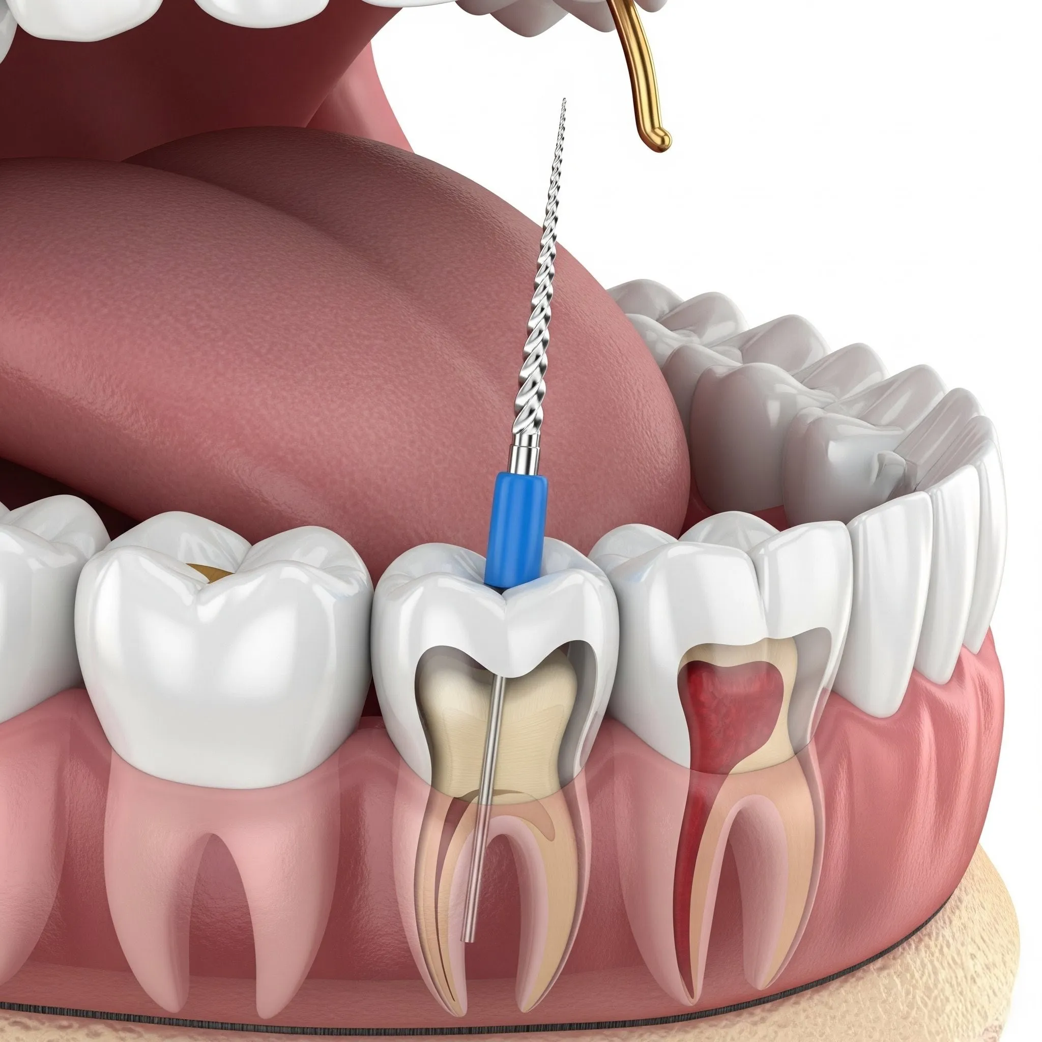 Understanding Endodontics