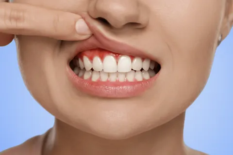 Understanding Gingivitis