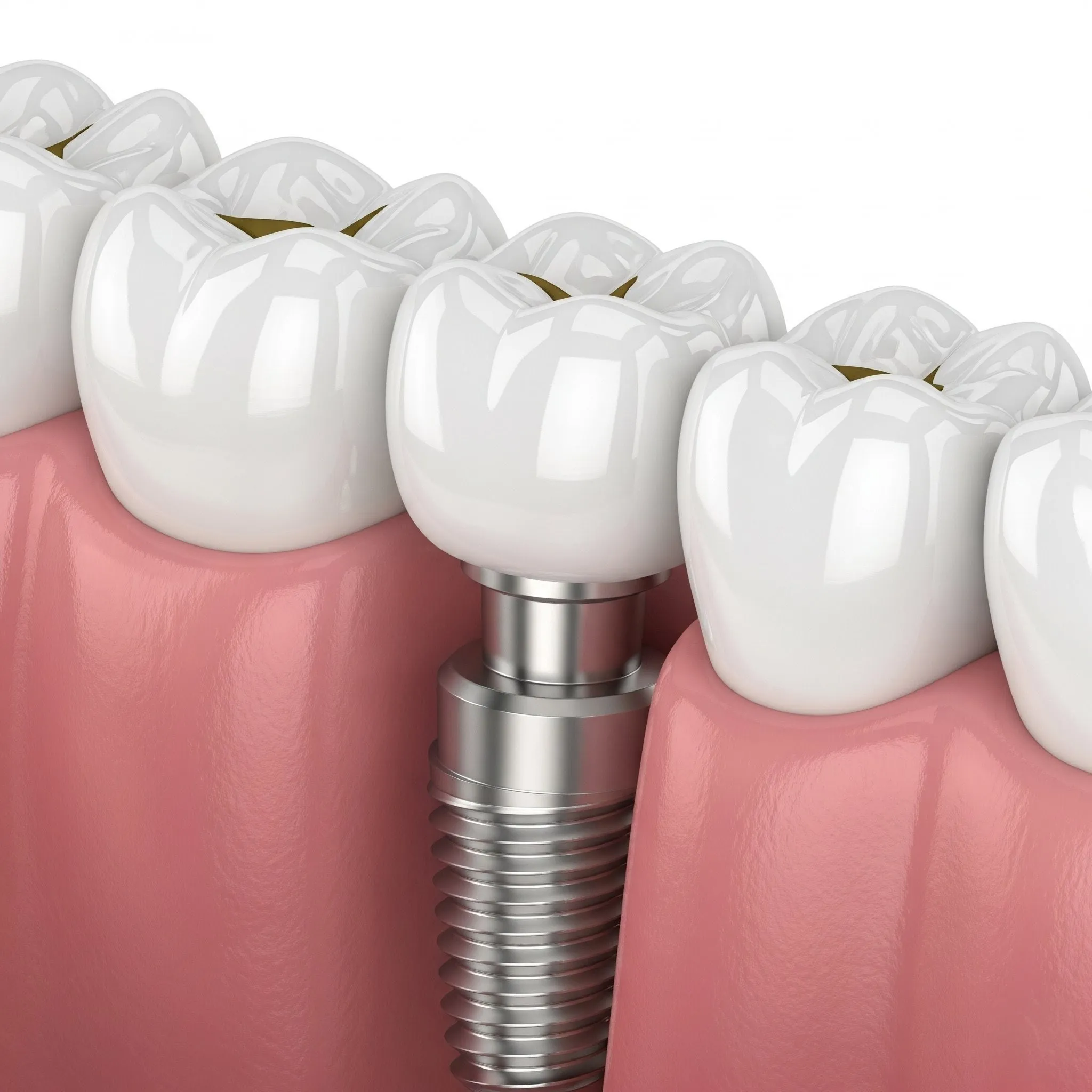 Prosthodontic Appliances